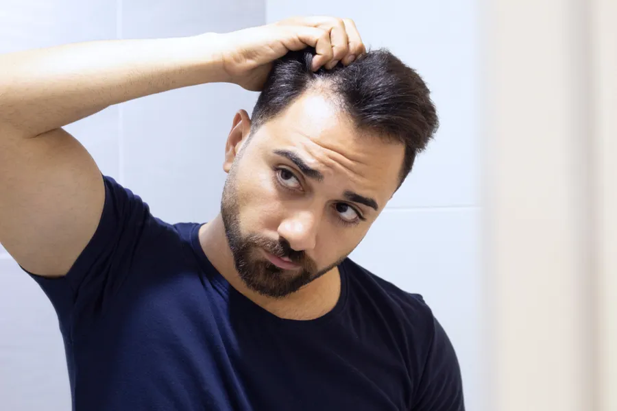 A man in a navy t-shirt looks in the mirror worrying about and touching his receding hairline, considering PRP for hair loss and restoration treatment from Balanced Medical Solutions in San Francisco Bay Area.